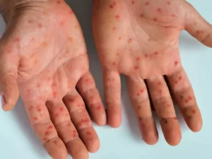 São Paulo registra 41 novos casos de mpox em uma semana, com concentração na zona sudeste