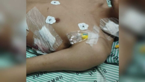 Três meses depois de perder parte do pulmão, jovem termina tratamento em Campo Grande